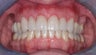 Invisalign, implants, whiteing and veneers