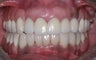 Smile makeover