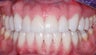 Veneers