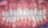 Smile makeover with Invisalign and Crowns
