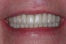 Smile makeover