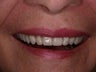 Dentures