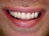 Extreme Smile Makeover