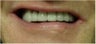 Full mouth Rehabilitation (Smile Makeover)