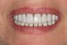 Porcelain Veneers