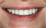 Full Mouth Reconstruction