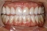 Full Mouth Smilemaker after treating TMJ