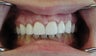 Gum lift (Crown Lengtheing), Root coverage with soft tissue Graft, 