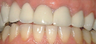 crown lengthening on temporary crowns