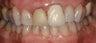 porcelain crowns and porcelain veneers