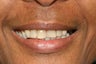 Smile Makeover