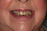 Smile Makeover