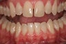 Porcelain Crowns 