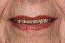 Esthetic Reconstruction
