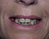 Sedation Dentistry