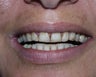 Crowns, Implants and Veneers