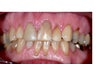 Full Mouth Reconstruction