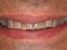 Tetracycline Repair