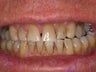 Full Mouth Makeover