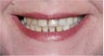 Smile Makeover with crowns and veneers