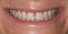 Smile Makeover