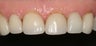 Porcelain Veneers and Crowns