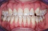 Veneers