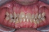 Smile makeover with Invisalign and Crowns