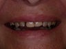 Dentures