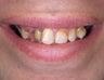 Extreme Smile Makeover