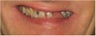 Full mouth Rehabilitation (Smile Makeover)