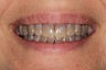 Porcelain Veneers