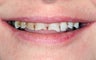 Full Mouth Reconstruction