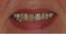 Porcelain Veneers and Dental Crowns