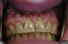 Gum lift (Crown Lengtheing), Root coverage with soft tissue Graft, 