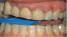 crown lengthening on temporary crowns