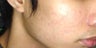 Acne Treatment with Smoothbeam