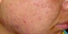 Acne Treatment with Smoothbeam