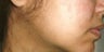 Acne Treatment with Smoothbeam