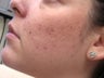 Acne/Acne Scars Treatment with Smoothbeam