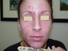SmoothBeam Laser for Acne