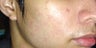 Acne Treatment with Smoothbeam