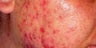 Acne Treatment with Smoothbeam