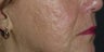 Smoothbeam laser