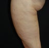 SmoothShapes Cellulite Treatment