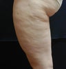 SmoothShapes Cellulite Treatment