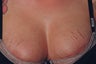 Stretch Mark Removal on the Breasts Before and after Laser