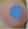 Vascular Laser for Red Stretch Marks of the breast