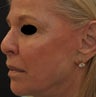 TCA Full-Face Chemical Peel