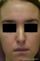 Melanage Chemical Peel for Melasma